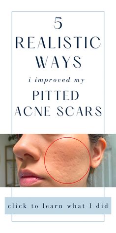 Guide to teach you how to get rid of pitted acne scars