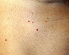 These are the most common causes of red spots on your skin, including psoriasis, keratosis pilaris, also known as chicken skin, rashes, and more, as explained by dermatologists and doctors. Red Spots On Face, Red Skin Spots, Red Freckles, Heat Rash, Skin Rashes