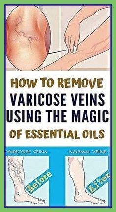 Varicose Veins Essential Oils, Body Coach, Organic Health, Tooth Decay, Organic Oil