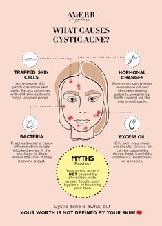 What Causes Acne, Esthetician Posts, Natural Remedies For Acne, Remedies For Acne, Natural Acne Remedies, Types Of Acne, Acne Causes