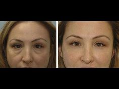 Removing Eye Bags, Malar Bags, Massaging Techniques, Face Massaging, Face Rejuvenation, Aesthetic Surgery, Remove Eye Bags, Face Yoga Exercises, Face Yoga Facial Exercises