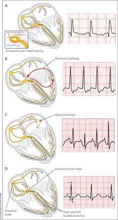 three diagrams showing different types of heart valves and their corresponding ectomgrams, including the