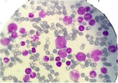 Myeloproliferative Disorders Essential Thrombocythemia, Myeloproliferative Neoplasms, Molecular Genetics, White Blood, White Blood Cells, Red Blood, Blood Cells