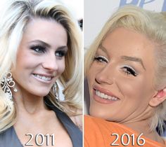 Courtney Stodden before and after veneer Veneers Before And After, Cosmetic Dentistry Veneers, Veneers Teeth, Bottle Blonde, Teeth Whitening Remedies, Laser Teeth Whitening, Fake Teeth