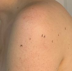 the back of a man with acne on his shoulder