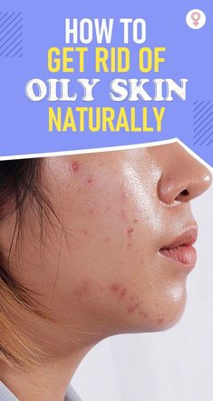 Home remedies to get rid of oily skin are easy to implement and can give you the desired results. Read to know more about them and tips to prevent oily skin. Deep Pimple, Oily Nose, Get Rid Of Oily Skin, Prevent Oily Skin, Oily Skin Remedy, Skin Care Products Design, Acne Overnight