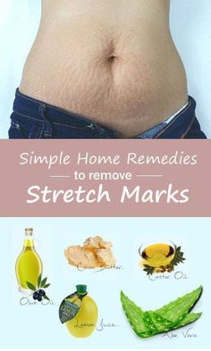 Strech Marks Remedies, Stretch Mark Tattoo, Get Rid Of Spots, Strech Marks, Stretch Mark Remedies, Lotion For Oily Skin, Stretch Mark Removal, Baking Soda Shampoo, Stretch Mark