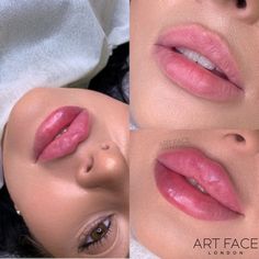 After Lip Fillers, Russian Lips, Lip Pump, Aesthetics Clinic, Lips Inspiration, Aesthetic Nurse, Wax Roller, Lip Augmentation