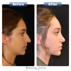 #istanbul #plasticsurgery #beforeafter #beforeandafter #beforeafterpics #rhinoplastybeforeafter #before #after #medicalcenterturkey #pinterest #pinterestinspired #rhinoplasty #nosejob #nose #nosesurgery Kpop Plastic Surgery, Nose Plastic Surgery, V Line Surgery, Korean Plastic Surgery