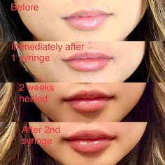 1 Syringe Lip Filler, Get Fuller Lips Naturally, 1ml Lip Filler, Restylane Lips, Nose Surgery Rhinoplasty, Juvederm Lips, Fuller Lips Naturally