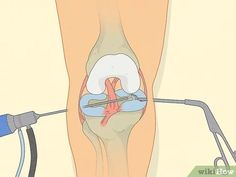 10 Ways to Heal a Meniscus Tear - wikiHow Meniscus Surgery Recovery, Knee Meniscus, Aching Knees, Knee Pain Relief Remedies, Meniscal Tear, Knee Pain Remedy, Knee Pain Relief Exercises, Knee Exercise