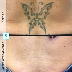 Laser tattoo removal at Removery Lower Back Tattoo, One Tattoo, Laser Tattoo, Laser Tattoo Removal, Tattoo Removal, The Expert, First Tattoo, Tattoo You, Lower Back Tattoos