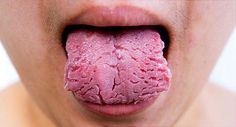 Colors, spots, patches, and lumps can all give you clues about your health. Find out from WebMD what your tongue is telling you. Cracked Tongue, Healthy Tongue, Tongue Sores, Candida Yeast Infection, Yeast Infection Causes, Candida Yeast, Candida Diet, Body Healing