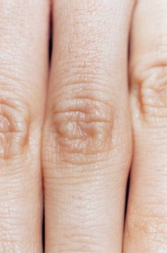 a close up of a person's hand with an unhealthy ring on it