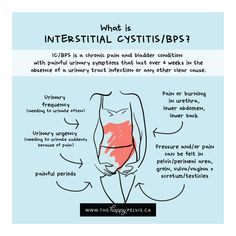 Suicide risk in patients with Interstitial Cystitis/BPS - The Happy Pelvis Bladder Control Exercises, Bladder Leakage Remedies, Bladder Exercises, Painful Bladder Syndrome, Bladder Prolapse, Kegel Exercise For Men, Pelvic Health, Bladder Leakage, Pelvic Floor Dysfunction