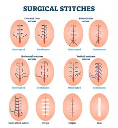 the surgical stitches chart shows different types of surgery and how they are used to treat them