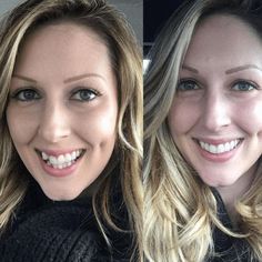 Invisalign Before And After, Veneers Before And After, Invisalign Aligners, Kids Braces, People Smiling, Traditional Braces, Veneers Teeth, Clear Aligners