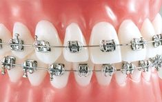 If you need braces, or have a family member who needs braces, you may be wondering if you are too old to get them. The good news is there is really no age limit, and getting braces as an adult is getting more common all the time. Braces Problems, Braces Transformation, Different Types Of Braces, Braces Retainer, Damon Braces, Types Of Braces