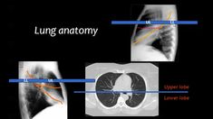 an x - ray shows the location of lung anatomy and how it is made up