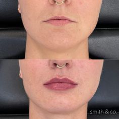 Small Lips Filler, Kysse Lips Filler, Lip Filler Before And After, Lip Filler Technique, Lip Fillers Juvederm, Lip Lift, Botox Before And After, Danielle Smith