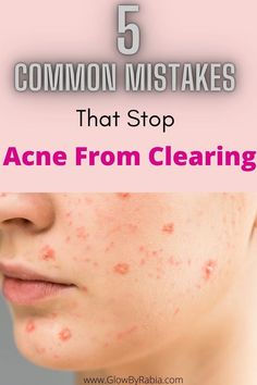 10 proven Ways to Get Rid of Hormonal Acne Naturally Acne Map, Acne Face Map, Get Rid Of Acne Fast, Face Map, Face Mapping Acne, Bad Acne, Acne Scarring