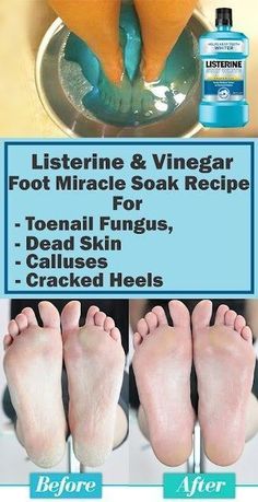 Pin on Home Remedys Listerine Foot Soak, Foot Soak Recipe, Toenail Fungus, Beauty Remedies, Nail Fungus, Skin Care Remedies, Foot Care, Beauty Treatments