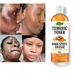 Hyperpigmentation and Dark Spots by Ruth Gonzalez | This newsletter was created with Smore, an online tool for creating beautiful newsletters for educators, businesses and more Apple Cider For Face, Hyperpigmentation Mask, Normal Skin Care Routine, Turmeric Scrub, Acne Soap, Brown Spots Removal, Skin Photo, Dark Spots On Skin, Lightening Creams