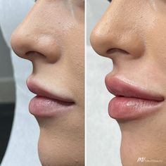 Hip Filler, Natural Lip Fillers, Natural Filler, Lip Surgery, Dairy Free Breastfeeding, Facial Contouring