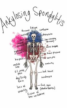 Ankylosing spondylitis autoimmune chronic pain inflammation Spondylosis Ankylosing, Ankylosing Spondyloarthritis, Ankylosing Spondylosis, Immune Disorders, Auto Immune, Pro Athletes, Chronic Fatigue, Autoimmune Disease, 21 Days