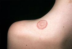 What’s itchy, scaly, round, and contagious? Ringworm, of course. Find out what it is, what causes it, what the symptoms are, and how it’s treated. Fungal Rash, Nail Remedies, Fungal Nail, Fungal Infection, Natural Treatments, Skin Problems, Ayurveda