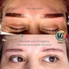 Ombre Brows Gone Wrong Why This Happens & What to Do? Ink Removal, Ombre Brows, Permanent Cosmetics, Gone Wrong