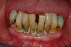 Severe #periodontitis: Sixth most prevalent health condition in the world. #dentalcare #dentistry #cosmeticdentistry #periodontaldisease  | http://www.sciencedaily.com/releases/2014/09/140926141012.htm Periodontal Disease, General Dentistry, Patient Education, Cosmetic Dentistry, Health Conditions, Dental Implants, Dental Care, Healthcare Professionals