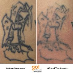 before and after photos of tattoo removal