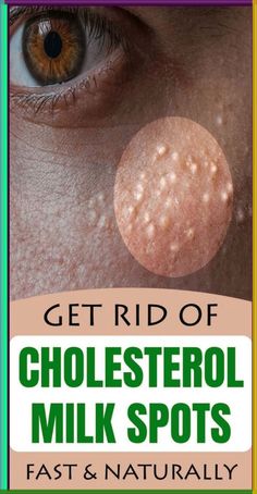 7 Remedies To Get Rid Of Cholesterol Milk Spots Naturally Bill Tracker, Dream Symbols, Skin Disorders, What Happened To You, Health Remedies, Hair Removal, Natural Remedies, Fitness Tips, Health Tips