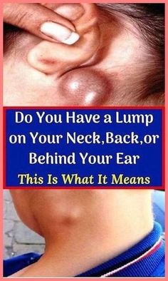 DO YOU HAVE A LUMP ON YOUR NECK, BACK OR BEHIND YOUR EAR? HERE�S WHAT YOU NEED TO KNOW Lump Behind Ear, Muscle Knots, Skin Bumps, Healthy Lifestyle Tips, Natural Home Remedies, Health Info, Home Health, Health Healthy