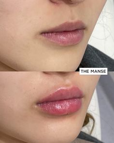 Smooth Skin Body, Lip Flip, Botox Before And After, Beauty Skin Quotes, Korean Lips, Cheek Fillers