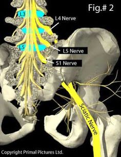 Sciatica - spondylolisthesis can be a cause, a slippage of one vertebral body on top of another that may be a result of fracture or a genetic defect in the pars interarticularis. Stretches For Sciatica, L5 S1, Sciatic Nerve Relief, Sciatica Stretches, Therapeutic Yoga, Sciatica Exercises, Sciatica Relief, Yoga Anatomy, Nerve Pain Relief