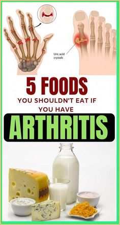 5 Foods You Should Never Eat If You Have Arthritis Uric Acid Crystals, Reduce Thigh Fat, Exercise To Reduce Thighs, Tongue Health, Uric Acid, Baking Soda Shampoo, Fat Fast, Food Lists, Health Remedies