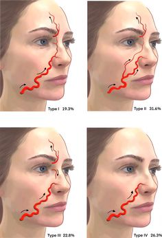 Vascular complications from soft tissue fillers can have catastrophic consequences for patients. Adverse events are rare, but they are increasing, and their appearance may be the result of intravascular injection. A comprehensive understanding of the 2-dimensional anatomy (distribution) and 3-dimens … Facial Injections, Skin Anatomy, Facial Anatomy, Dental Photography, Facial Treatments, Injectables Fillers, Facial Aesthetics, Nasolabial Folds, Botox Fillers