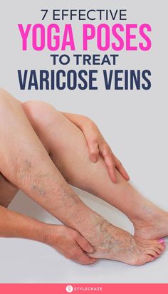 Home Remedies For Spiders, Varicose Veins Causes, Varicose Vein Remedy, Fish Pose, Creme Anti Age, Basic Yoga, Cool Yoga Poses, Natural Treatments, Health Wellness