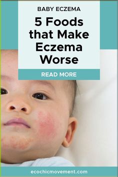 In the blog, the skincare experts at Eco Chic Movement are sharing tips about how to soothe your child's eczema. When it comes to natural treatments for baby eczema, that actually work, the key is to get to the root cause of the problem. And that starts by understanding what eczema really is. We share details so you can understand eczema and share our tips for soothing it for our baby. Natural Skin Care Products | Skin Concern | Eczema | Skin Care Tips Excema Diet For Kids, Excema Remedies For Kids, Baby Excema, Natural Skin Care Products, Health Talk, Exercise Tips, Parenting 101, Eco Chic