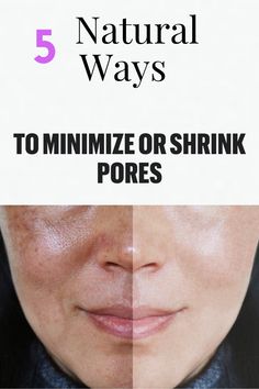 Make Pores Smaller, Big Pores, Lotion For Oily Skin, Nose Pores, Face Pores, Oily Skin Acne, Open Pores