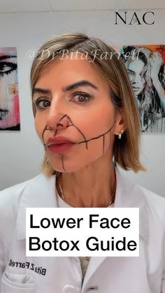 Face Botox Areas, Botox Face Mapping, Botox Units, Botox For Headaches, Botox Around Mouth, Botox Mapping, Botox Facial, Face Procedures, Botox Training