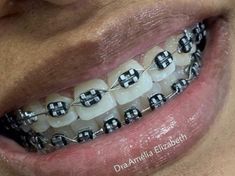 Black Braces No Power Chain, Straight Teeth With Braces, Metal Braces Colors, Brackets Aesthetic, Braces For Teeth, Jewelry Teeth