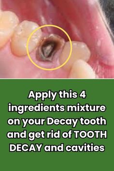 Decayed Tooth, Home Gum, Grow Back Receding Gums, Teeth Remedies, Tooth Decay Remedies, Teeth Whitening Homemade, Heal Cavities, Sick Remedies