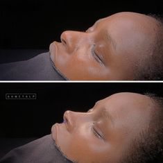 Nose Job Inspiration Black, Wide Bridge Nose Rhinoplasty, Rhinoplasty Black Women, Nasiolabel Folds Filler, Black Nose Job, Turkey Nose Job, Ethnic Rhinoplasty African Americans, Black Rhinoplasty, Nose Job Black Women