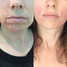 EmFace Review — I Tried The New Skin Treatment That Lifts Without Needles Facial Plastic Surgery, Saggy Skin, Facial Exercises, Affordable Skin Care