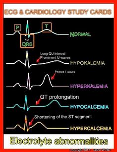 the ecd and cardioly study cards have different types of hypocaliaia