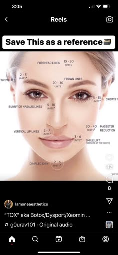 Botox Placement Chart, Injector Nurse, Medspa Decor, Lower Face Lift, Medical Esthetics, Aesthetic Nurse Injector, Clinic Aesthetic, Botox Injection Sites, Botox Clinic