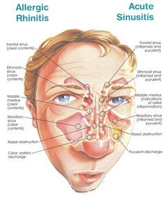 Sinus Medicine, Acute Sinusitis, Maxillary Sinus, Congestion Relief, Allergic Rhinitis, Sinus Congestion, Medical Anatomy, Sinus Infection